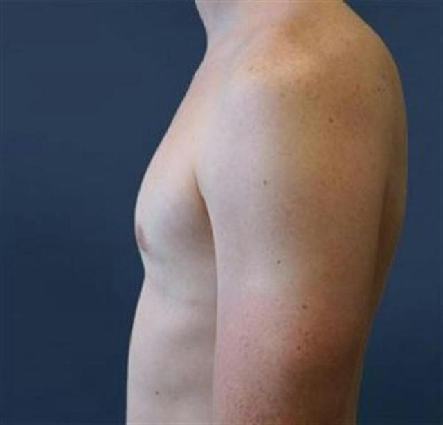Gynecomastia Surgery after at Basu Plastic Surgery in Houston, TX