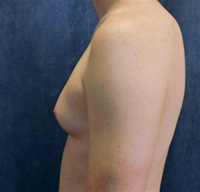 Gynecomastia Surgery before at Basu Plastic Surgery in Houston, TX