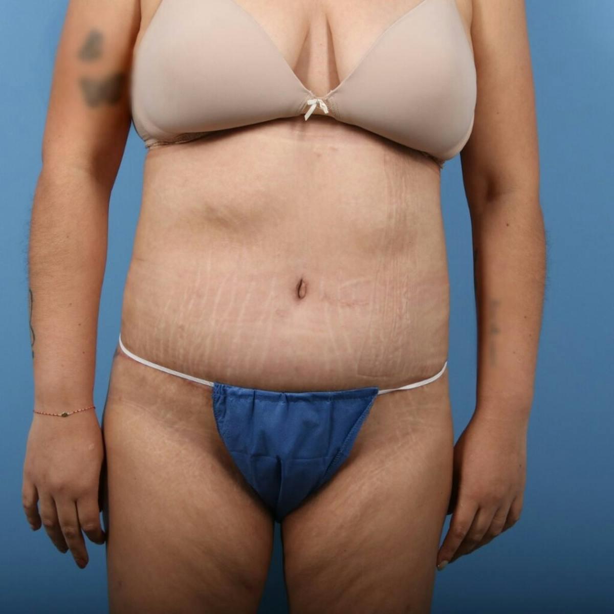 Basu Plastic Surgery body lift after — Houston, TX