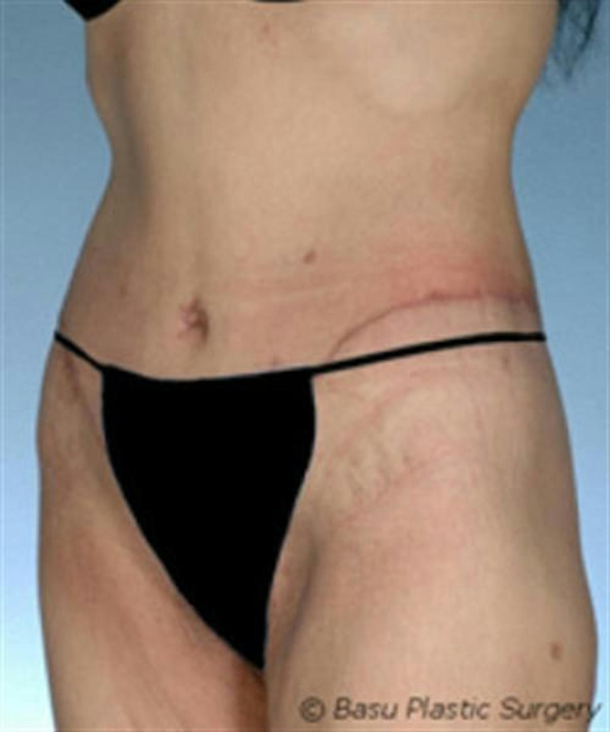 Basu Plastic Surgery body lift after — Houston, TX