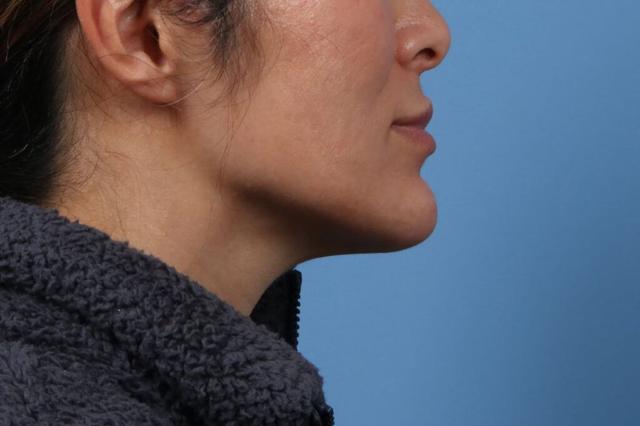 Chin Implant after at Basu Plastic Surgery in Houston, TX