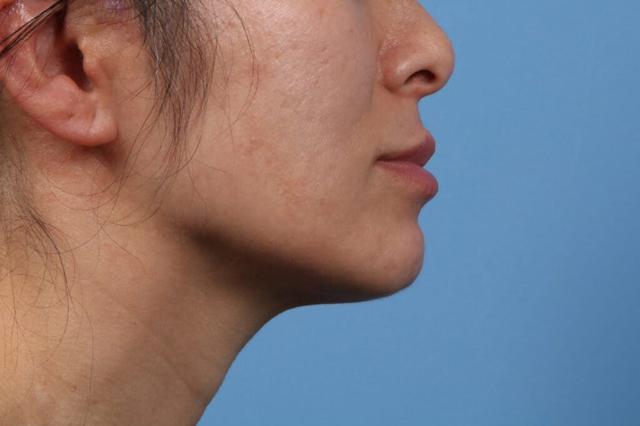 Chin Implant before at Basu Plastic Surgery in Houston, TX