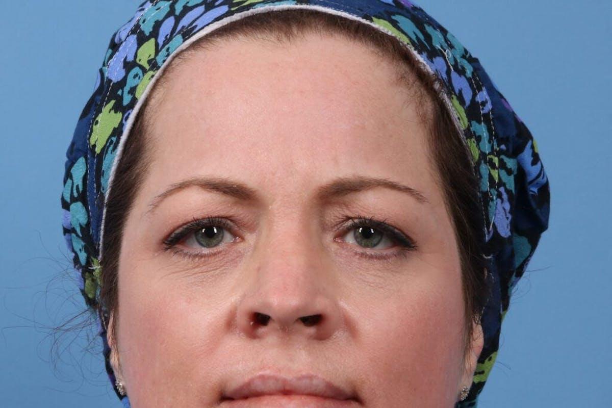 Basu Plastic Surgery blepharoplasty after — Houston, TX