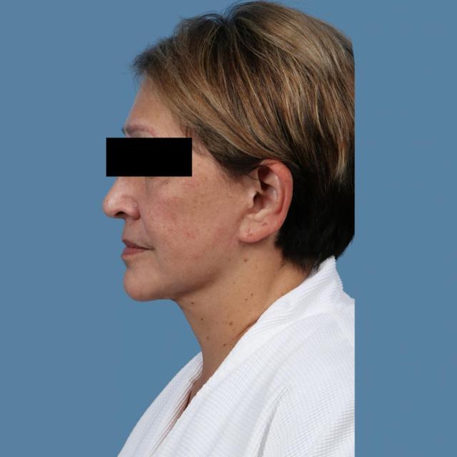 Neck Lift after at Basu Plastic Surgery in Houston, TX