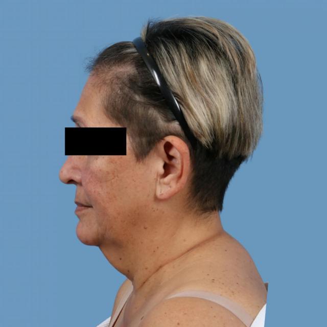 Neck Lift before at Basu Plastic Surgery in Houston, TX