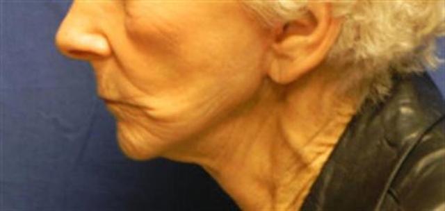 Neck Lift after at Basu Plastic Surgery in Houston, TX