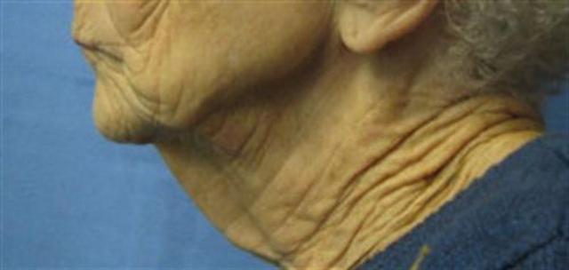 Neck Lift before at Basu Plastic Surgery in Houston, TX