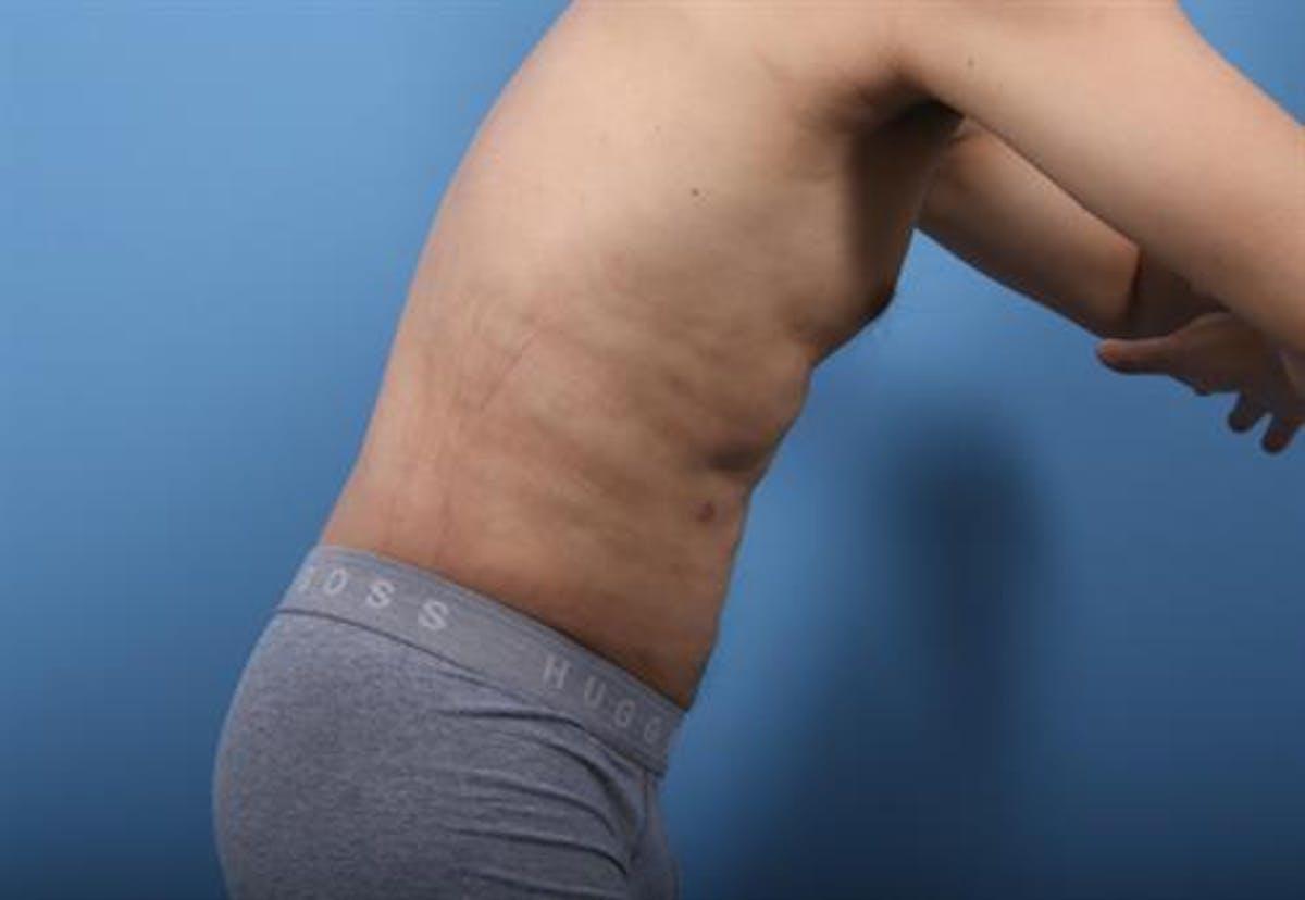 Basu Plastic Surgery liposuction after — Houston, TX