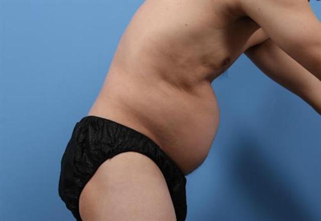 Liposuction before at Basu Plastic Surgery in Houston, TX