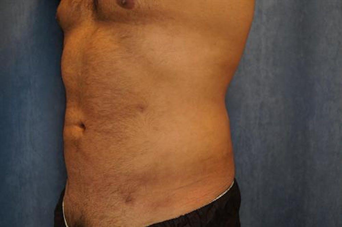 Basu Plastic Surgery liposuction after — Houston, TX