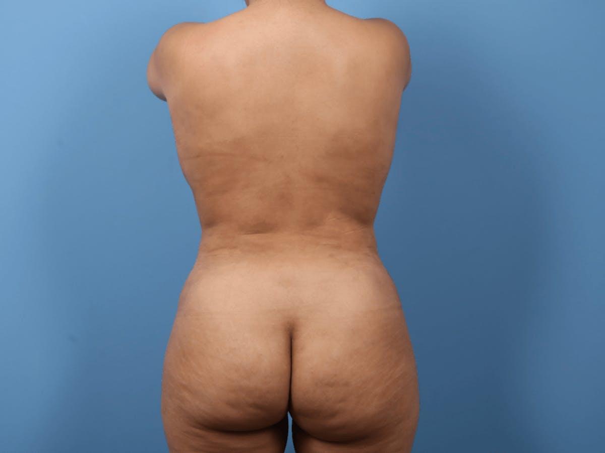 Basu Plastic Surgery liposuction after — Houston, TX
