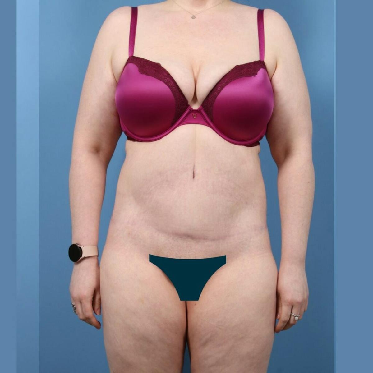 Basu Plastic Surgery body lift after — Houston, TX
