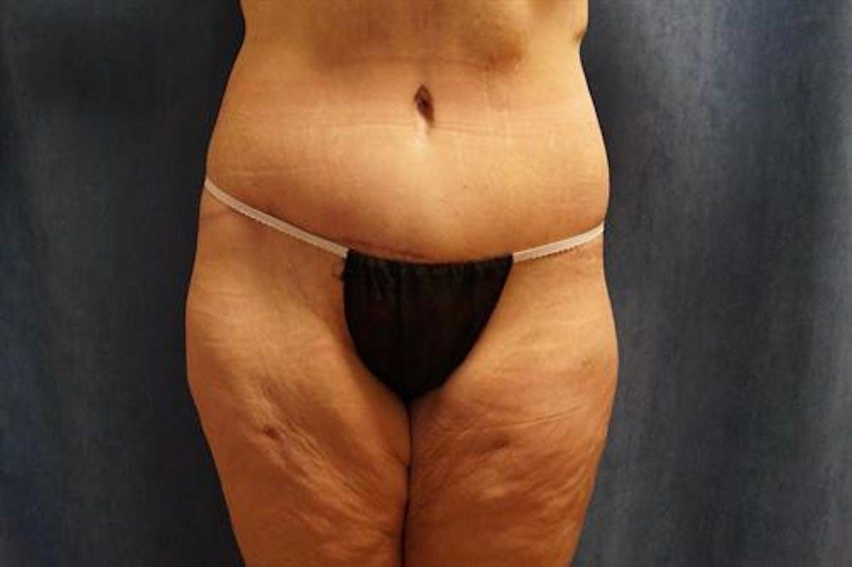 Basu Plastic Surgery body lift after — Houston, TX