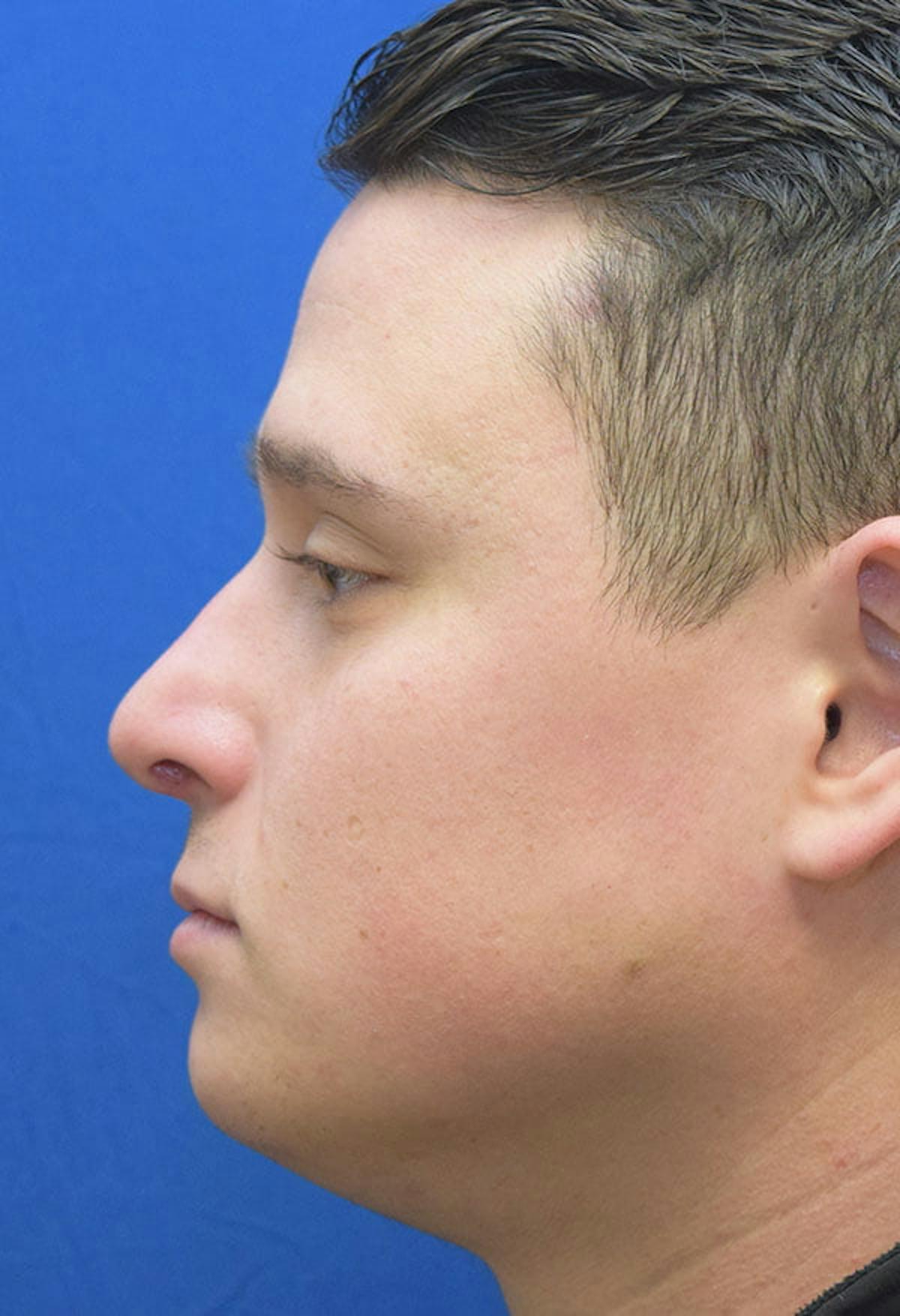 Basu Plastic Surgery rhinoplasty after — Houston, TX