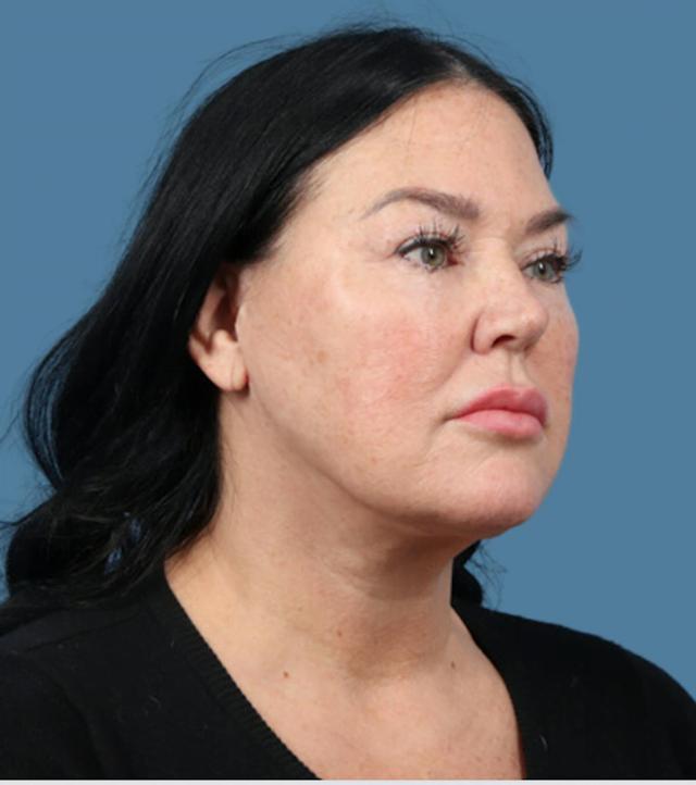 Neck Lift after at Basu Plastic Surgery in Houston, TX