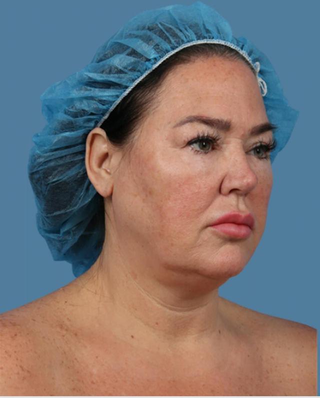 Neck Lift before at Basu Plastic Surgery in Houston, TX