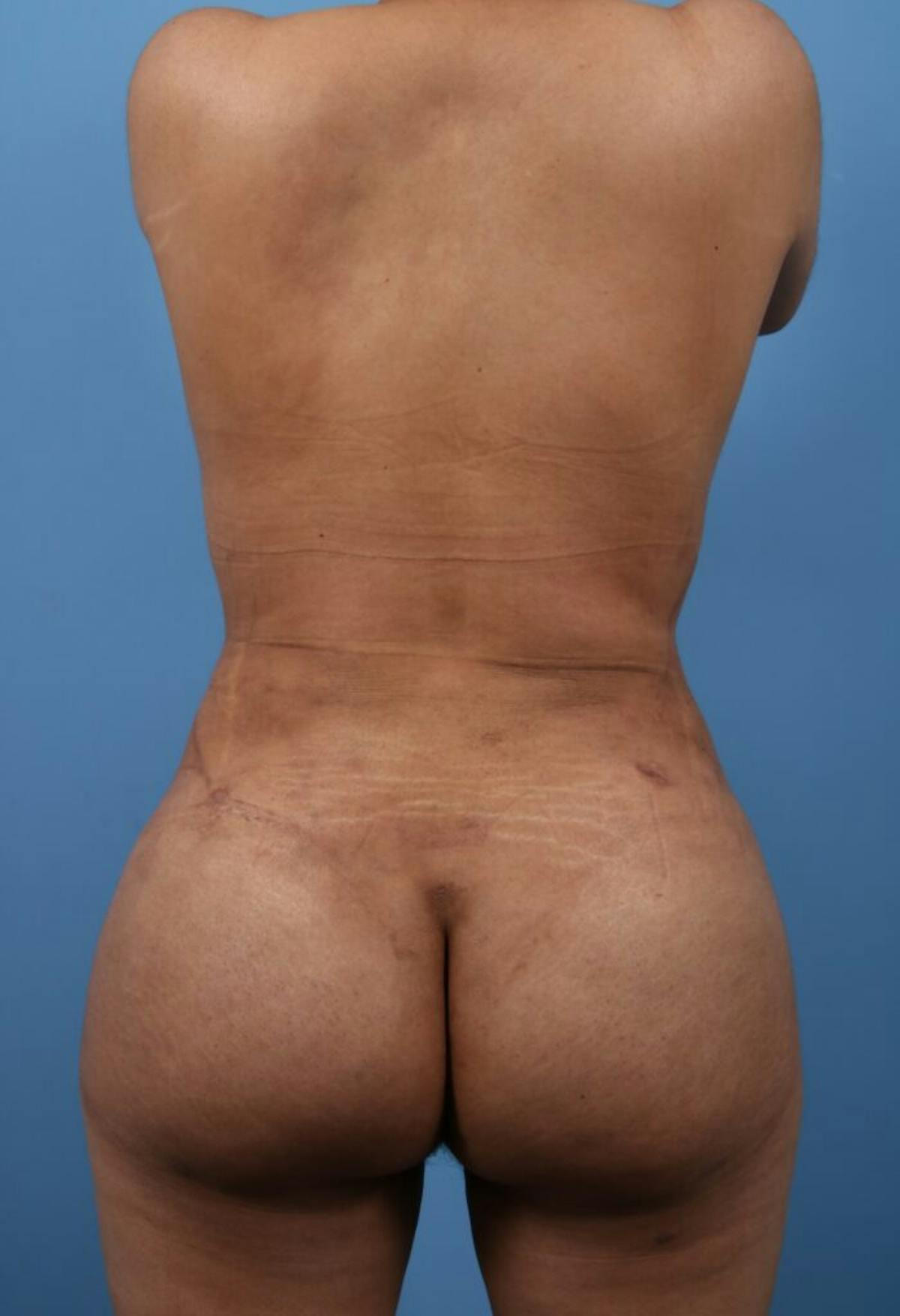 Basu Plastic Surgery bbl after — Houston, TX