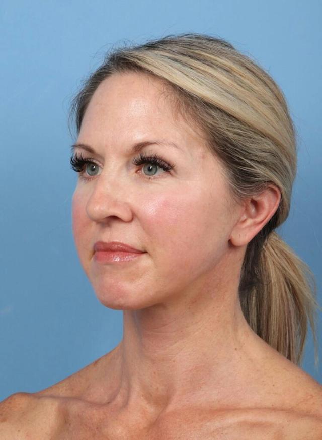 Neck Lift after at Basu Plastic Surgery in Houston, TX