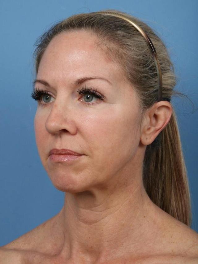 Neck Lift before at Basu Plastic Surgery in Houston, TX