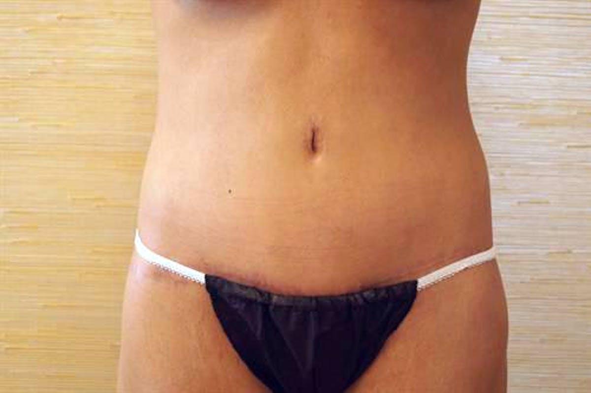 Basu Plastic Surgery body lift after — Houston, TX