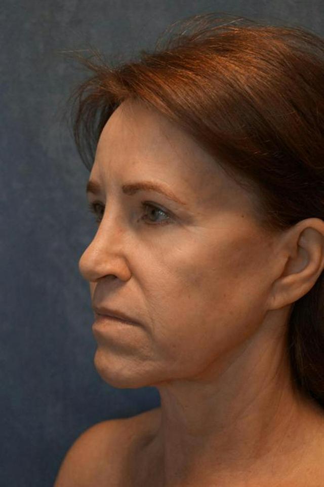 Fat Transfer before at Basu Plastic Surgery in Houston, TX