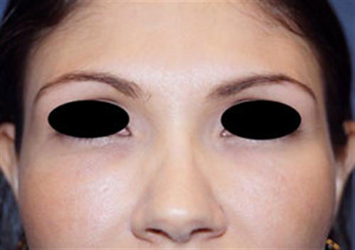 Basu Plastic Surgery fat transfer after — Houston, TX