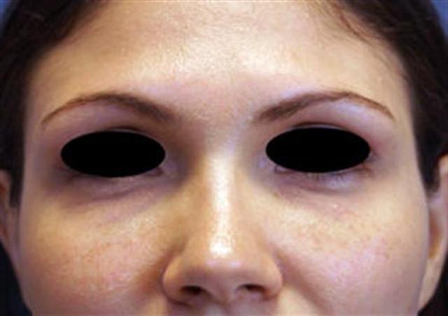 Fat Transfer before at Basu Plastic Surgery in Houston, TX