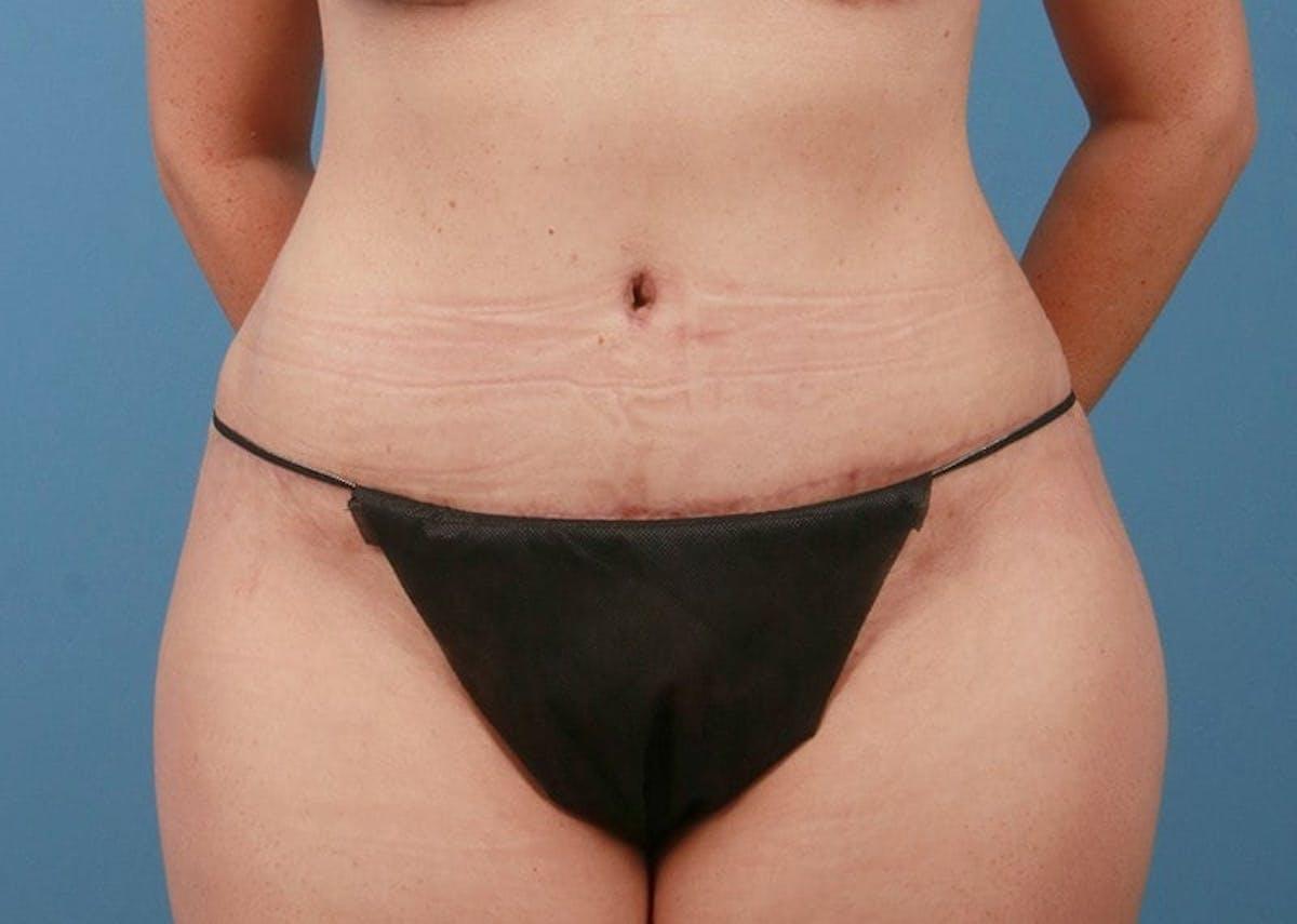 Basu Plastic Surgery tummy tuck after — Houston, TX