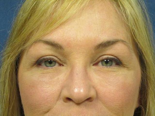 Fat Transfer after at Basu Plastic Surgery in Houston, TX