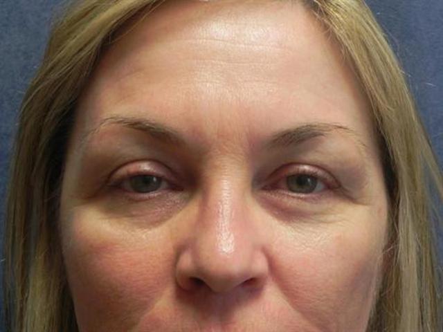 Fat Transfer before at Basu Plastic Surgery in Houston, TX