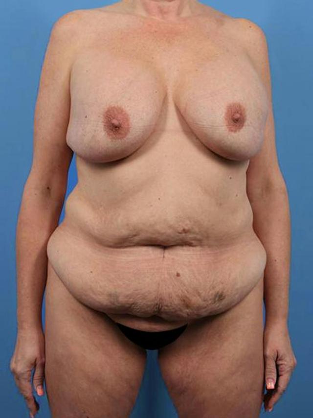 Mommy Makeover before at Basu Plastic Surgery in Houston, TX
