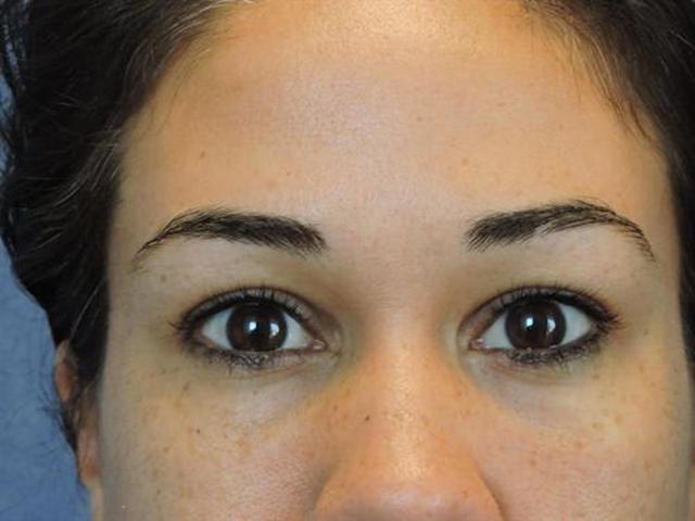 Fat Transfer after at Basu Plastic Surgery in Houston, TX
