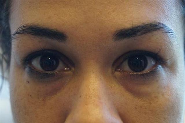 Fat Transfer before at Basu Plastic Surgery in Houston, TX