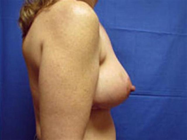Breast Lift after at Basu Plastic Surgery in Houston, TX