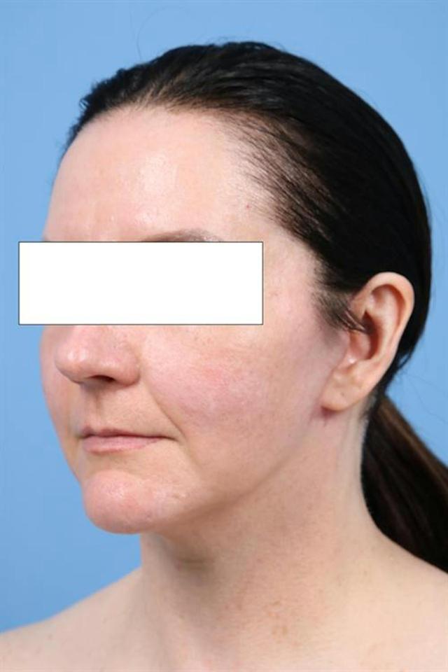 Neck Lift after at Basu Plastic Surgery in Houston, TX