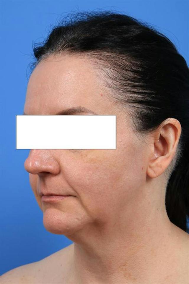 Neck Lift before at Basu Plastic Surgery in Houston, TX