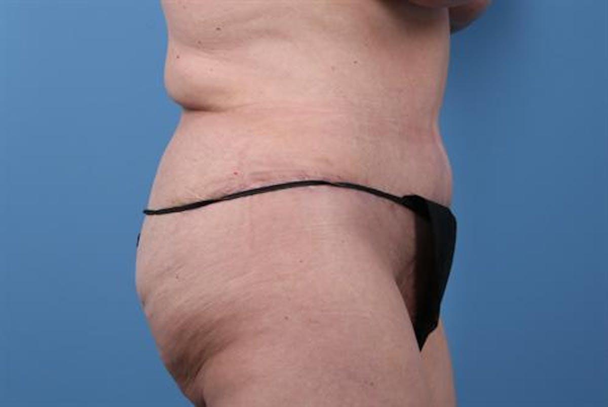 Basu Plastic Surgery body lift after — Houston, TX