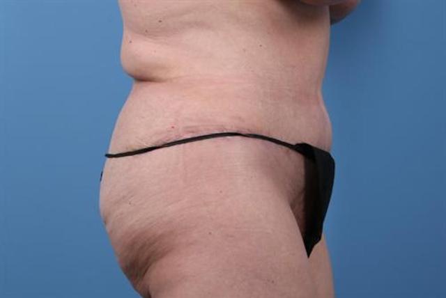 Mini Tummy Tuck after at Basu Plastic Surgery in Houston, TX
