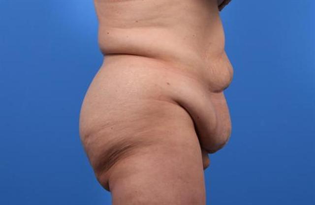 Mini Tummy Tuck before at Basu Plastic Surgery in Houston, TX