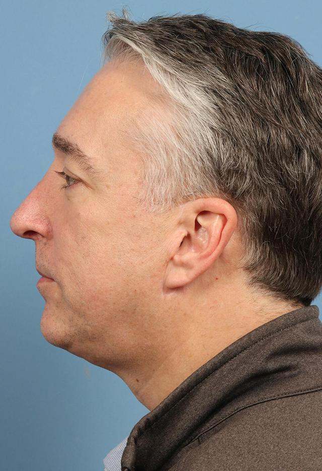 Facelift before at Basu Plastic Surgery in Houston, TX