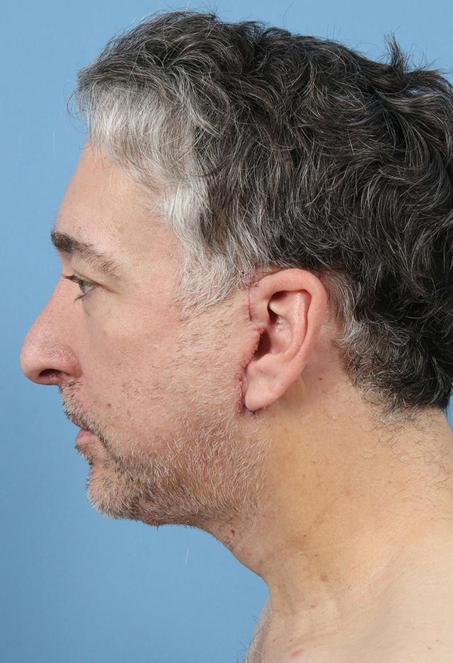 Facelift after at Basu Plastic Surgery in Houston, TX