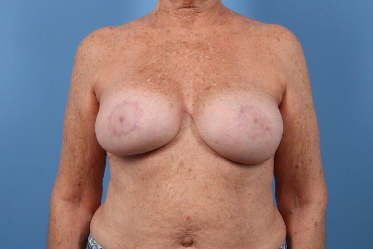 Basu Plastic Surgery breast augmentation after — Houston, TX