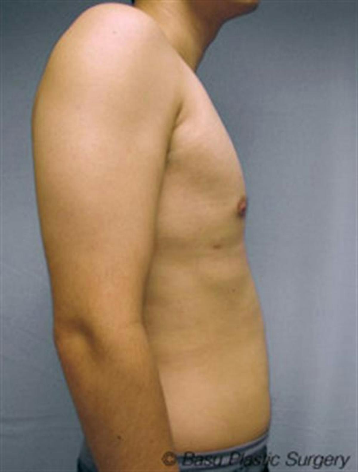 Basu Plastic Surgery liposuction after — Houston, TX