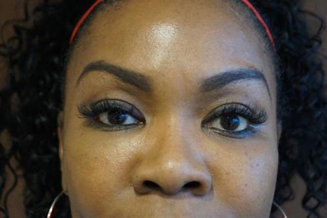 Fat Transfer after at Basu Plastic Surgery in Houston, TX