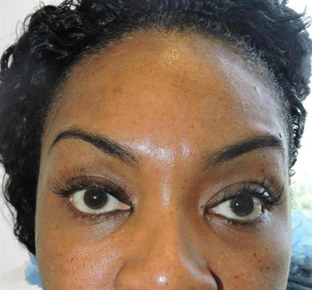 Fat Transfer before at Basu Plastic Surgery in Houston, TX