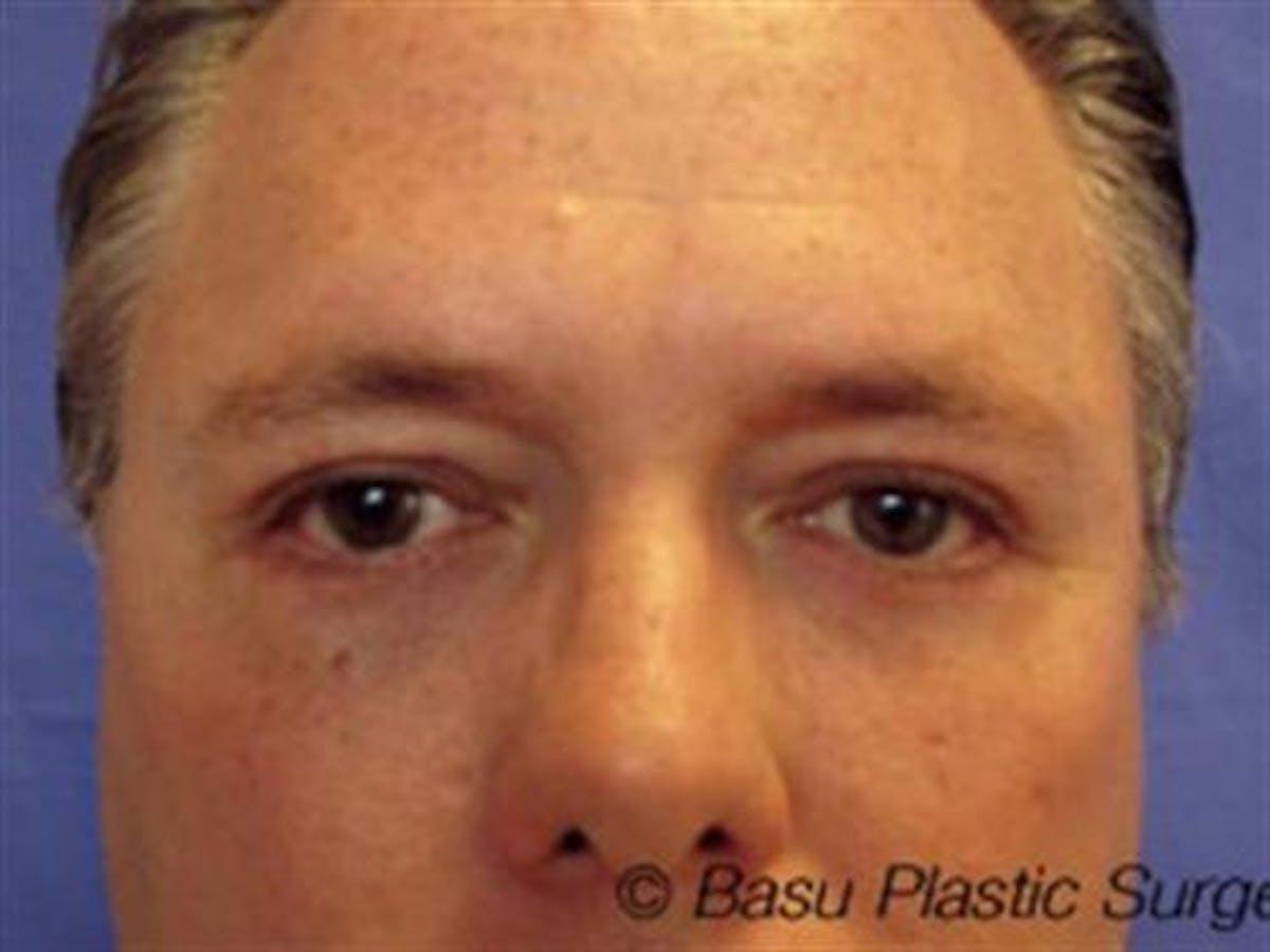 Basu Plastic Surgery blepharoplasty after — Houston, TX
