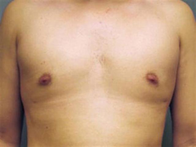 Gynecomastia Surgery after at Basu Plastic Surgery in Houston, TX