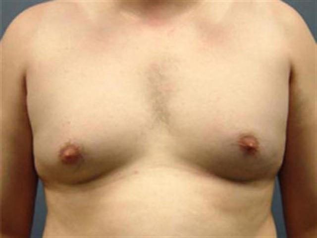 Gynecomastia Surgery before at Basu Plastic Surgery in Houston, TX