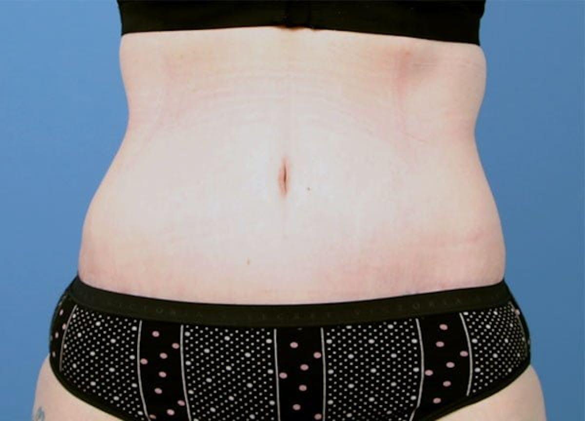 Basu Plastic Surgery tummy tuck after — Houston, TX