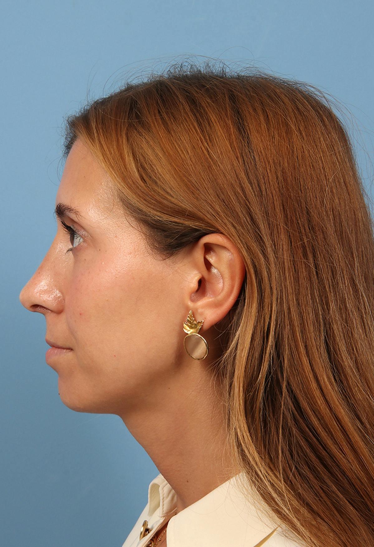 Basu Plastic Surgery rhinoplasty after — Houston, TX